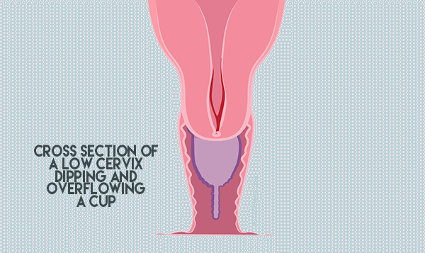 Illustration of a menstrual cup inside the vagina. The cup overfills and leaks.